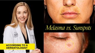 Understanding Melasma and Sunspots Key Differences Causes and Treatment Options [upl. by Eeliram860]