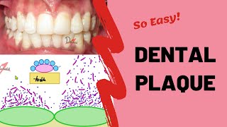 Dental Plaque  Types and Formation [upl. by Lovmilla663]