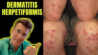 Dermatitis Herpetiformis rash seen in Coeliac Disease aka gluten intolerance explained [upl. by Gareth]