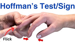 How to Perform a Hoffmans Test  Inverted Supinator Sign  Clonus  Hyperreflexia [upl. by Yenal135]