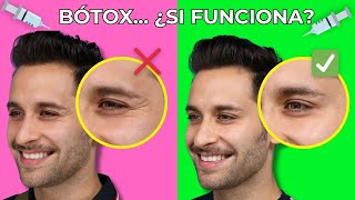 Bótox quotescrotoxquot y fillers para hombres ¿Sí o no [upl. by Ettelorahc531]