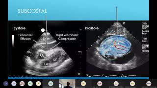 21 04 13 Pericardiocentesis lecture [upl. by Tipton]