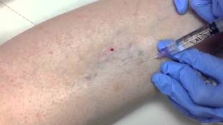 Sclerotherapy [upl. by Oman]