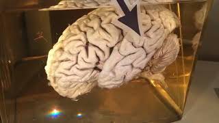 Einsteins brain A trip to the Mutter Museum in Philadelphia [upl. by Severn]