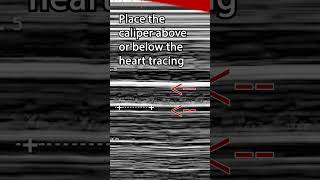 Fetal Heart Rate Pro Tip pocus ultrasound emergencymedicine obgyn pregnancyultrasound [upl. by Eitak]