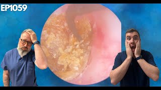 REMOVING THE MOST IMPACTED EAR WAX EVER  EP1059 [upl. by Monda]