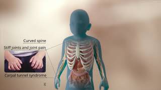 An Inside look at Mucopolysaccharidosis Type I MPS I [upl. by Arreip941]