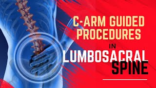 Mastering CArm Guided Interventional Pain Procedures at Lumbosacral Spine Tips for Pain Physicians [upl. by Aiksas920]