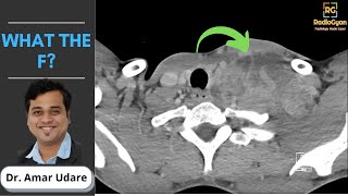 Virchows nodes Troisier sign and Cancer  Radiology Capsule [upl. by Ingrim244]