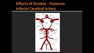 Effects of Strokes  Posterior Inferior Cerebral Artery [upl. by Ailes]