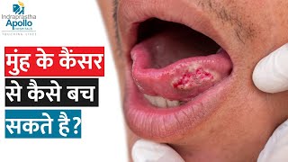 How Do We Diagnose Oral Cancer Quickly  Dr Anil D Cruz  Apollo Hospital [upl. by Nyliac963]