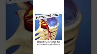 Herniated disc shorts mbbs femalereproductivesystem pregnancy [upl. by Etterrag]