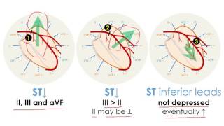 III LAD occlusions prox to D1 distal to S1 [upl. by Kenleigh]