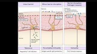 Mystery diagnosis Langerhans cell histiocytosis [upl. by Alaster16]