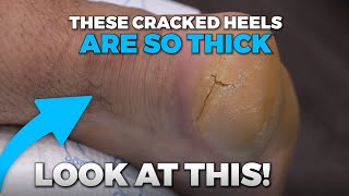 WHAT ARE THE TWO THINGS THAT CAUSES CRACKED HEELS [upl. by Hollister234]