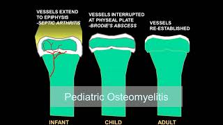 Imaging osteomyelitis acute and chronic [upl. by Byler]