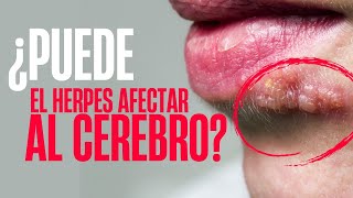 ¿El HERPES puede afectar al CEREBRO ENCEFALITIS HERPÉTICA [upl. by Einttirb]