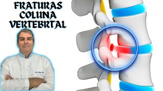 FRATURAS NA COLUNA VERTEBRAL Dr Prof Nelson Marques [upl. by Oiretule]