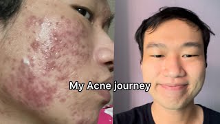 1 year before and after timelapse isotretinoinaccutane Journey  Very Severe Acne Scars treatment [upl. by Lumbye259]