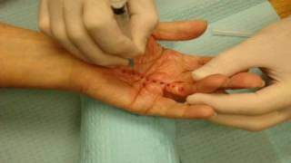 Needle Fasciotomy  Needle Aponeurotomy for Dupuytrens Contracture [upl. by Skrap]