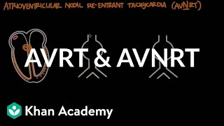 Atrioventricular reentrant tachycardia AVRT amp AV nodal reentrant tachycardia AVNRT [upl. by Neelehtak295]