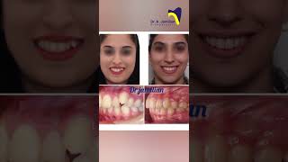 Miracle of Orthodontics Pre and Post orthodontic orthodontics orthodontist before after brace [upl. by Winnie567]