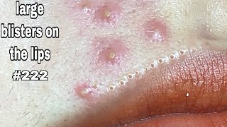 large blisters on the lips  part 222  B’Young Spa Quyet Hair [upl. by Bigler382]