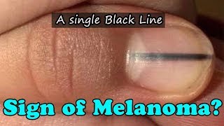 A single Black Line Running Through Nail Could Be a Sign of Melanoma [upl. by Combes]