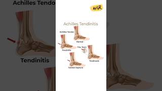 Achilles Tendon Injury  Ankle Pain achillestendon shorts [upl. by Bartholomew]