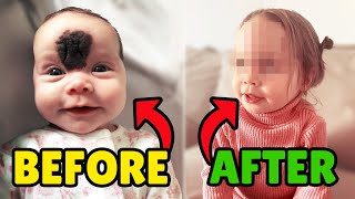 Little Girl Gets Birthmark Removed 😲 transformation [upl. by Engdahl]