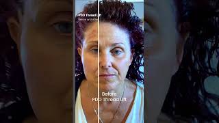 PDO Thread Lift Before and After Nonsurgical Facelift PCH MedSpa Newport Beach [upl. by Ocirderf]