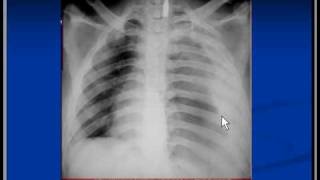 Chest xray interpretation hemothorax [upl. by Eckart]