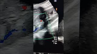 Renal Mass ultrasound abdomenangiomyolipomabening lesion [upl. by Midian]