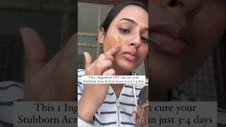 Acne Treatment at home  Remove Acne amp Acne Scars at home  Pimples treatment at home acnetreatment [upl. by Nue55]