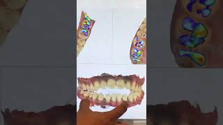 Invisalign Time Lapse  Invisalign Braces  Invisalign Before After invisalignsmile clearaligner [upl. by Iegres868]