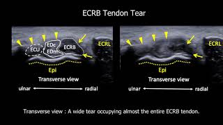 Adding a Transverse Scan in the Ultrasound Diagnosis of Extensor Tendinopathy [upl. by Notle142]