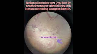 Epidermal inclusion cysthistologyskinpathologymedical [upl. by Susej]