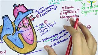 Tetralogy of Fallot TOF [upl. by Desdee]