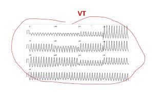 Ventriküler AritmilerVTVFVES [upl. by Hendrika]