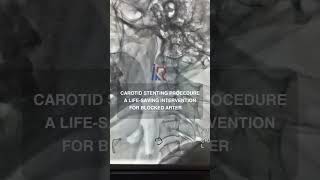 Carotid Artery Stenting brainstroke interventionalradiologist dralokkudiya stroketreatment [upl. by Panthea377]