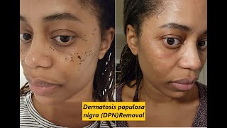 Dermatosis papulosa nigra DPN Removal [upl. by Lorens]