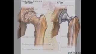 Titanium Implants Nickel MCV [upl. by Giorgio]