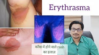 Erythrasma Black amp Red Spots in underarm below breast groin काँख में होने वाले rash का इलाज़ [upl. by Elokyn]