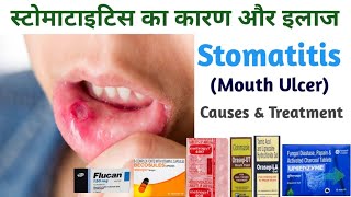 Mouth Ulcer Treatment  Stomatitis causes amp Treatment [upl. by Doykos]