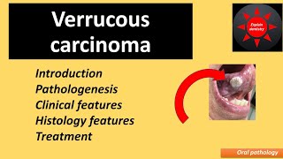 Verrucous carcinoma  oral pathology [upl. by Seely]