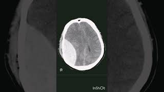 CT brain hemorrhage radiology traumaticbraininjury [upl. by Idden]