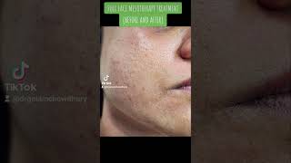 Full Face Mesotherapy TREATMENT BEFORE AND AFTER [upl. by Fleda]