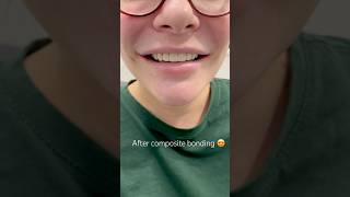 Before vs After composite bonding 🙌 veneers dentist compositebonding [upl. by Torbert375]