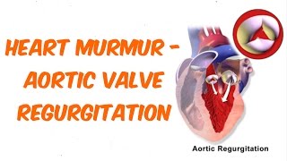 Aortic Regurgitation Auscultation Sound [upl. by Atnomed314]