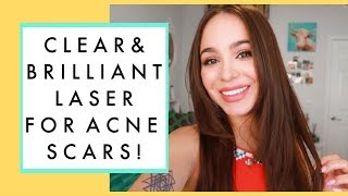 LASER TREATMENT FOR ACNE SCARS My 2 Week Progress [upl. by Gnahc950]